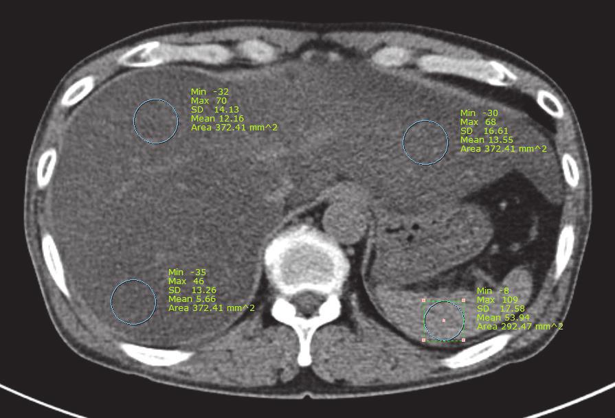 Mean liver attenuation (13 HU) was significantly lower than spleen attenuation (54 HU). pancreatitis [14].