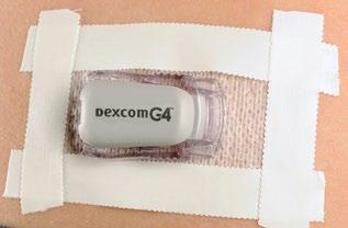 6 time to calibrate your sensor. Chapter 7, Calibrating Your Dexcom G4 PLATINUM System, tells you how to calibrate your sensor. 6.