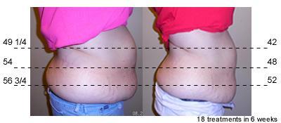 in 5.25 inches total loss One woman s