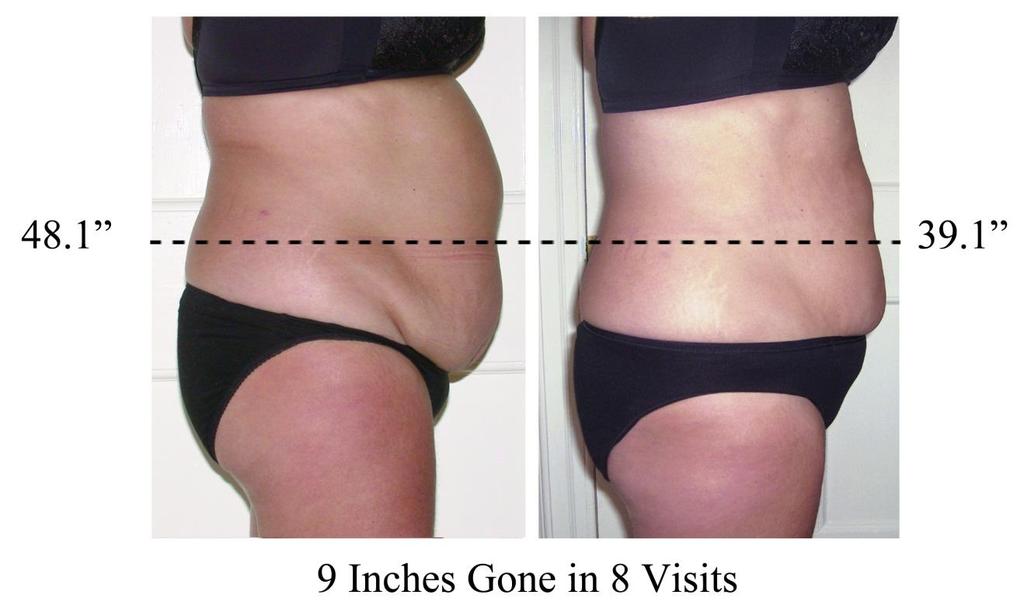 Like Everyone else, I was interested in losing inches, but was not interested in trying invasive procedures. Even with diet and exercise those stubborn areas were difficult to reduce.