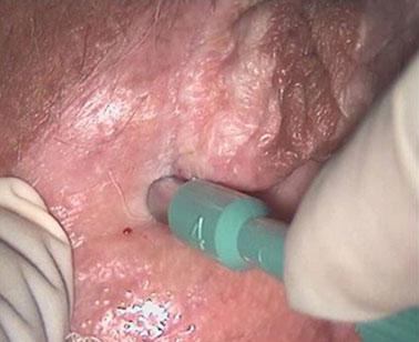 Squamous vulval cancer an update Diagnosis is made by biopsy of a suspicious lesion. If the lesion is small and well circumscribed it may be possible to perform a wide local excisional biopsy.