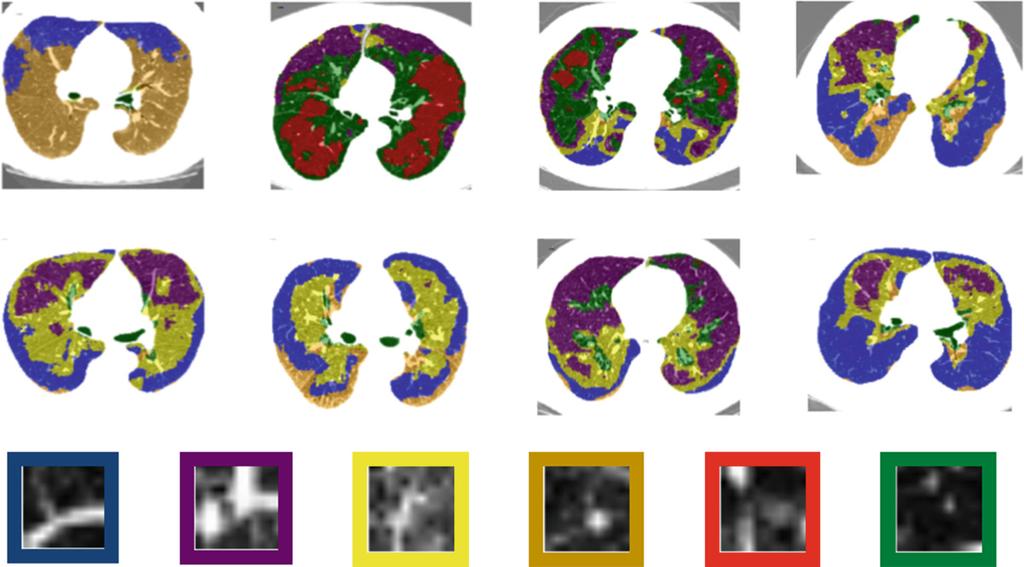 Unsupervised Discovery of Emphysema Subtypes 185 Fig. 2. Top two rows: example CT scans from each of the eight patient clusters identified by our algorithm.