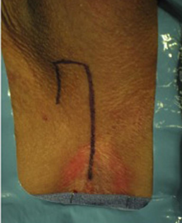 Translational Andrology and Urology, Vol 4, No 1 February 2015 53 Over-sewn distal urethral segment Lateral perineal skin flap tailored by the surgeon to reach the right urethrotomy in the proximal