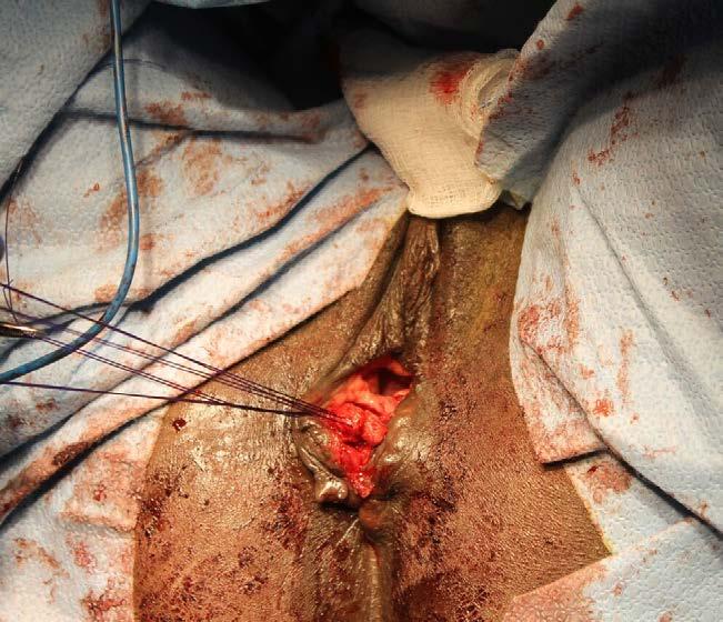 Lacerations Reconstruction