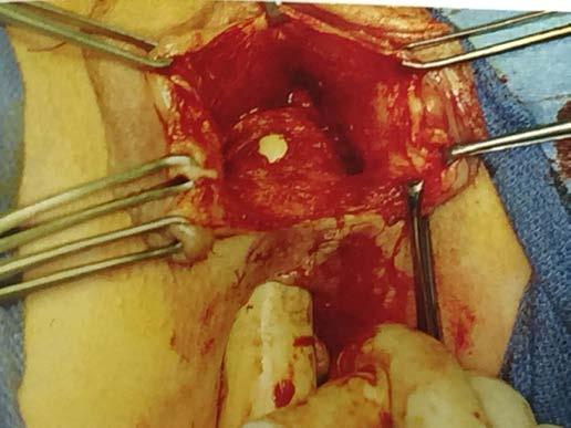 Surgical Approach to RVF Repair Wide mobilization (1-1.5cm) Toglia MR.