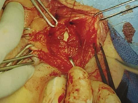 Surgical Approach to RVF Repair Closure of Rectal Mucosa (3-0 Vicryl) Toglia MR.