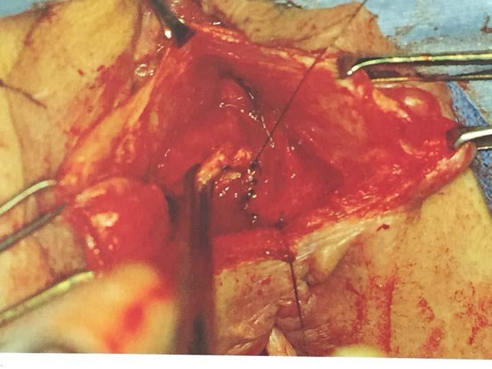 Surgical Approach to RVF Repair Imbrication of the Rectovaginal Connective Tissue Toglia MR. Rectovaginal and anovaginal fistulas. UpToDate. Waltham, MA: UpToDate Inc. http://www.uptodate.