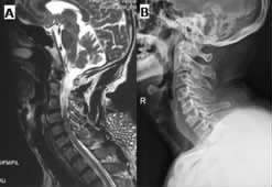 Table 4 Radiological results of two-level anterior cervical discectomy using stand-alone cages technique versus one-level corpectomy using plate-mesh technique in the surgical treatment of two-level