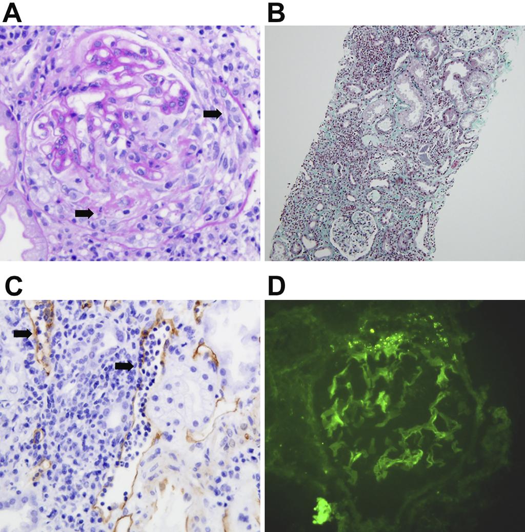 Figure 1. Light and immunofluorescence microscopic examinations of the renal biopsy specimens.