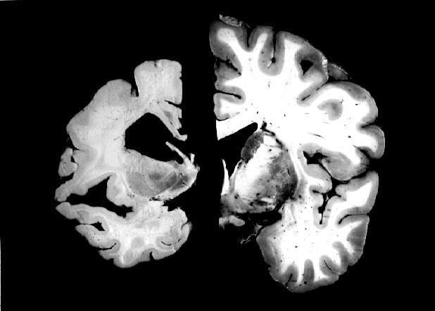 Brain atrophy from Alzheimer s disease AD brain