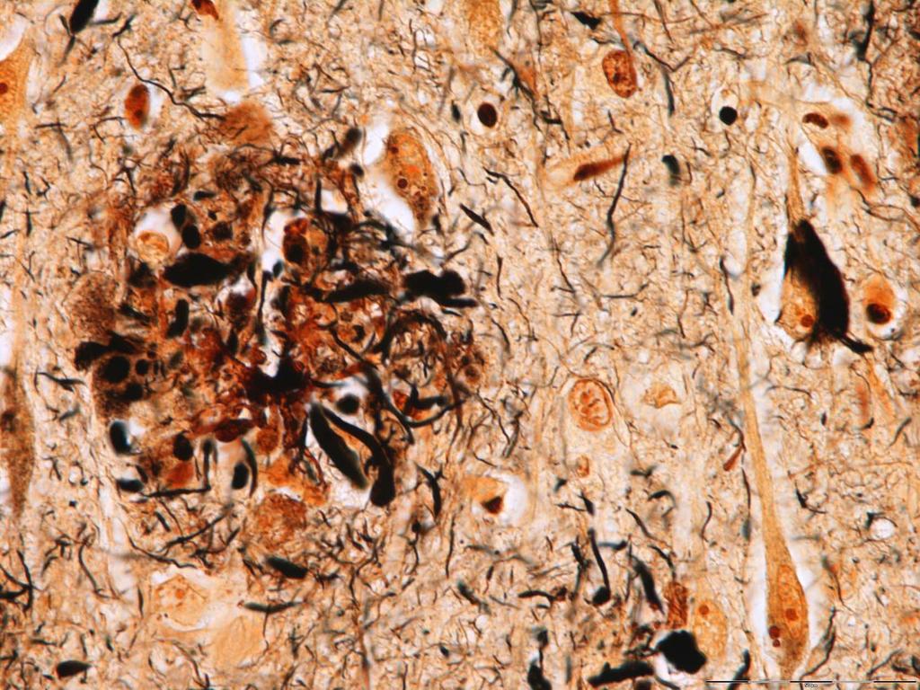 Pathologic Lesions of AD: Neuritic Plaque (left) and Neurofibrillary Tangle