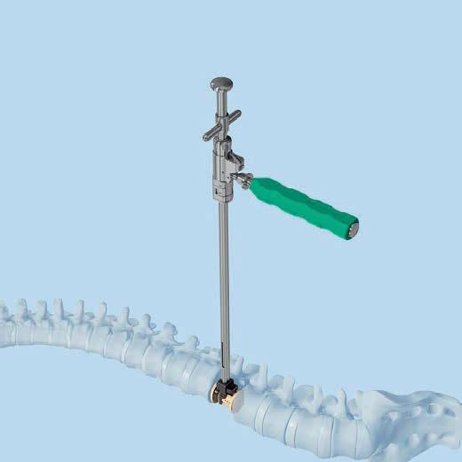 Guide and position the implant with the spreader. Slight distraction of the vertebral bodies may be necessary to ease insertion.