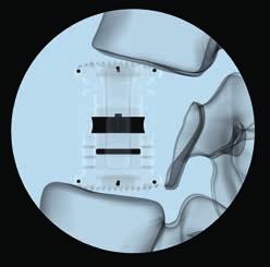 1 2 3 Verify the position of the implant using the image intensifier. The stop pin can be used to approximate the amount of distraction available.