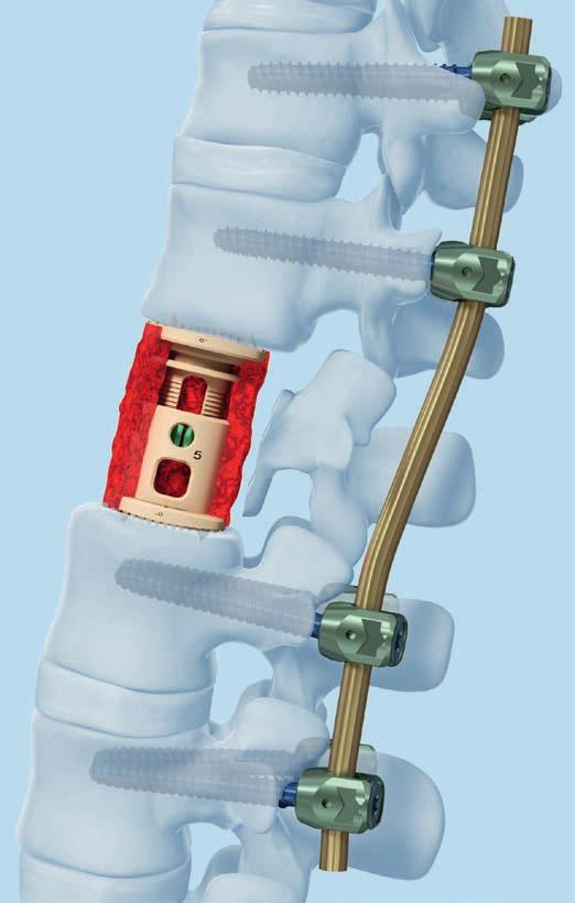 2 Apply internal fixation system For spinal stability and to maintain adequate compression on the construct, XRL must be used with an internal fixation system.