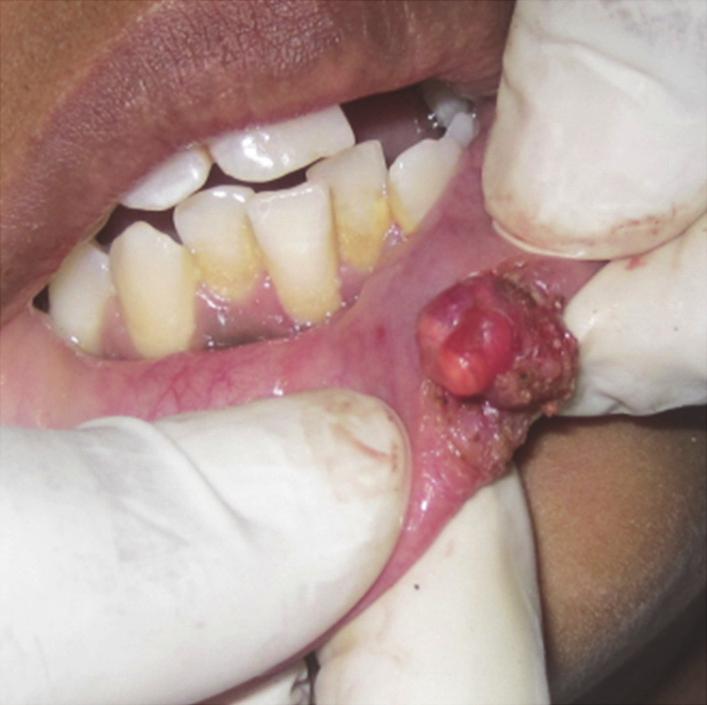 Histopathologic examination of mucocele often reveals formation of well-circumscribed, cyst-like space surrounded by granulation tissue and the presence of mucinophages in the collapsed wall of