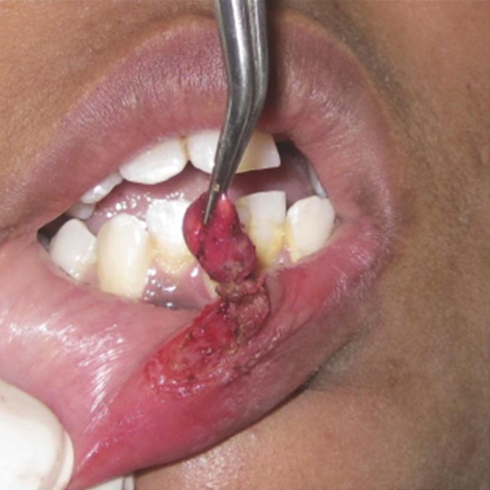 There are various treatment aspects available for the management of mucocele early: scalpel incision, complete surgical excision, marsupialization, micromarsupialization, intralesional injections of