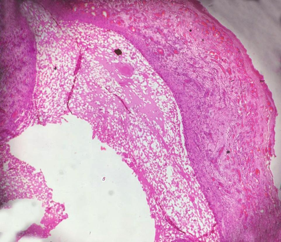 Figure 5: Photomicrograph showing H&E 40x view cystic cavity lined by thick fibrous capsule.