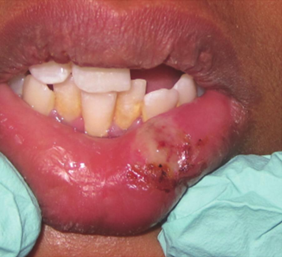 Area of adjacent coagulation ends with less bleeding at surgical site.