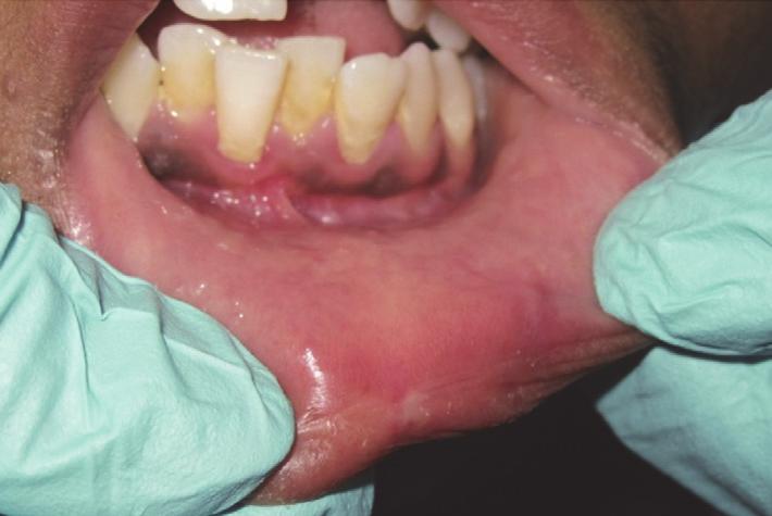 Conclusion Our present case report reveals knowledge about using diode laser for the treatment of mucocele with a variety of beneficial effects such as minimal anesthesia, less procedural timings,