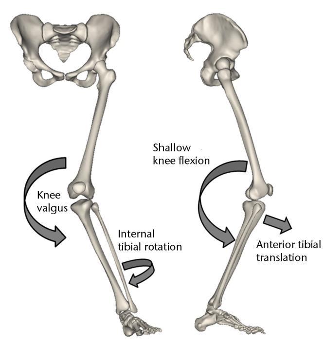 Figure 1: This is a diagram of the knee and the leg showing the rotations explained above that occur during most ACL tears.