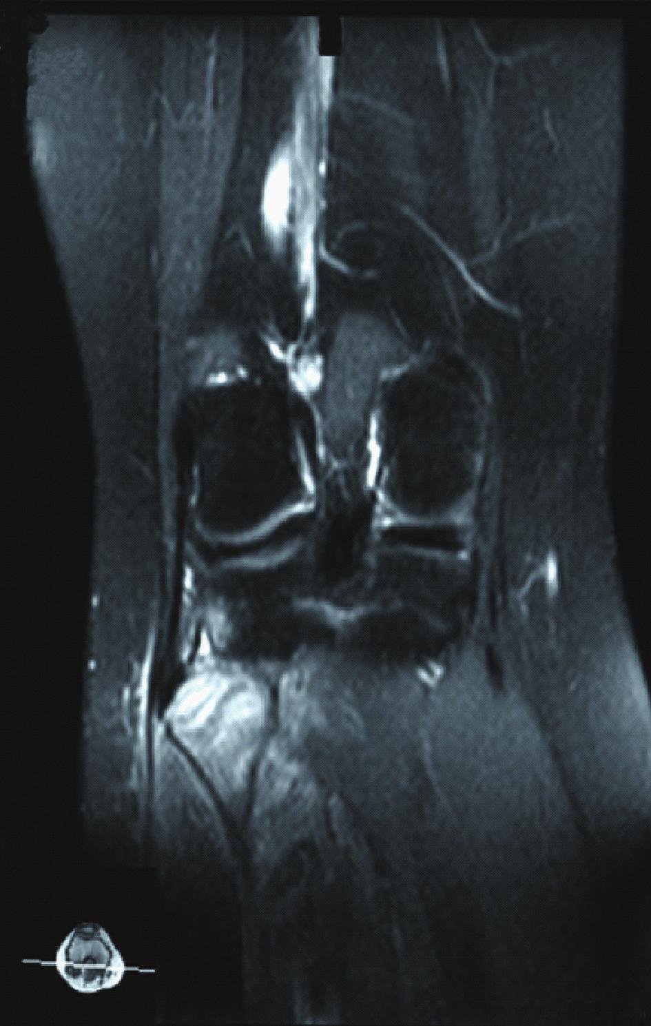 AP21Pos A Figure 3: MRI of the right