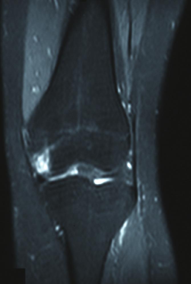 Case Reports in Medicine 3 E/M 15 Figure 4: MRI of the left knee showing medial condyle bruise as well as edema of the head of fibula due to fracture.