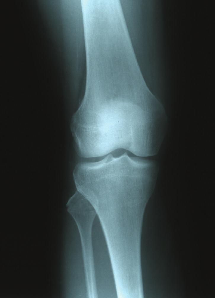 Several different types of avulsion fractures of the fibular head occur, however, related to the attachment sites of the many ligaments that attach to the fibular head.