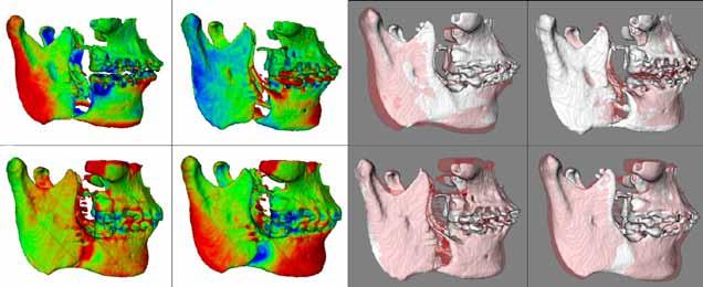 Motta ATS, Carvalho FAR, Oliveira AEF, Cevidanes LHS, Almeida MAO A B A B C D C D Figure 12 - Example of a mandibular advancement case showing superimpositions with color maps (left) and