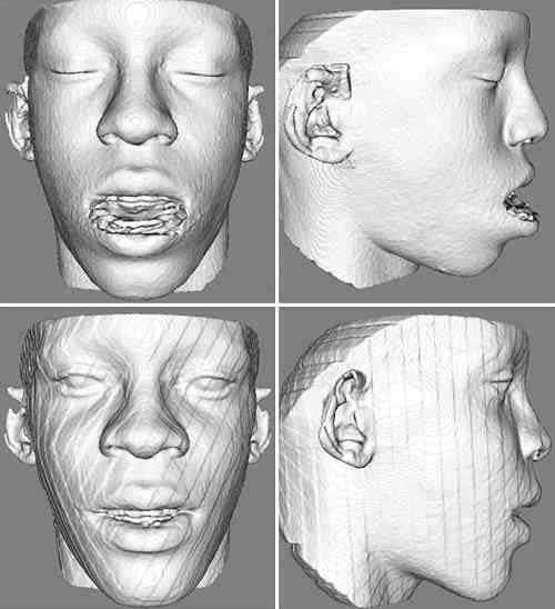 Superimposition A shows that the patient presented more vertical than horizontal changes with surgery, since there was a small overjet but deep overbite, and improvement of the lower facial height