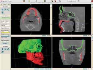 Motta ATS, Carvalho FAR, Oliveira AEF, Cevidanes LHS, Almeida MAO Figure 2 - After the registration procedure with the Imagine software, the superimposition between the post-surgery 3D model (color)