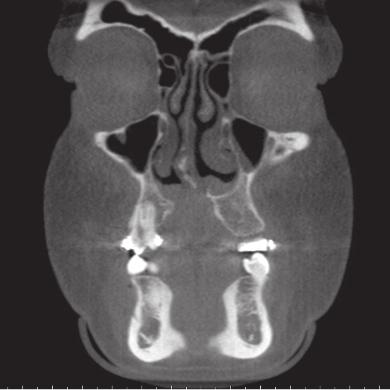 Common Uses Developing Dentition Cleft Palate and Bone Graft Assessment CBCT imaging has shown limited research that scans are reliable when determining the bony dimensions of a cleft palate (Figure
