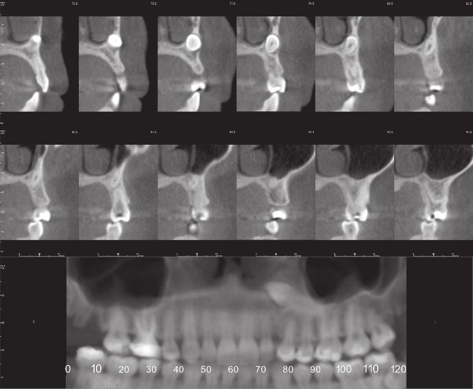 maxillary left third molar (black arrow) in relation to the maxillary sinus. Figure 1.18.