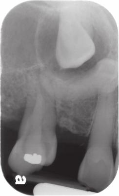 with a dentigerous cyst; (c) Cross-sectional
