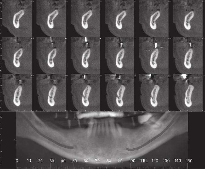 showing width of dentigerous cyst. Figure 1.25.