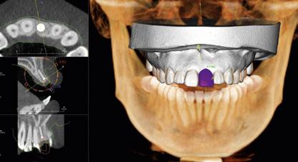 IMPLANTS Place and Restore with Accuracy and Confidence Treat patients with greater surgical predictability and confident outcomes using i-cat s 3D treatment