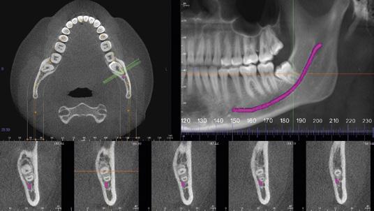 Determine precise position of impacted teeth within the alveolar bone, as well as their proximity to adjacent teeth and vital structures, such as the nerve canal, sinus walls, and cortical borders.