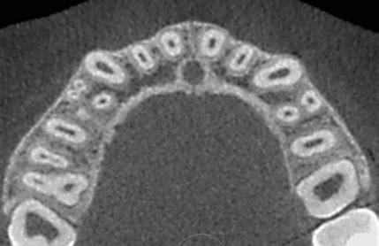 axial views Discover root fractures using cross-sectional views