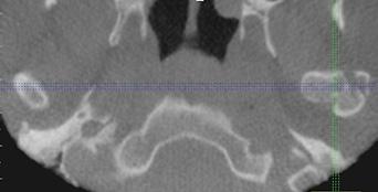TMJ Detect TMD and Assess Fractures Detect TMJ anomalies for the ability to design effective patient treatment.