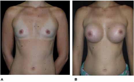 4 Motta Comparison between different methods of breast implant volume choice and degree of postoperative satisfaction showed no difference between them: MamaSize Group: 284,04mL; Implant Group: 280.