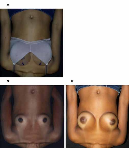 Motta Comparison between different methods of breast implant volume choice and degree of postoperative satisfaction 5 Figure 5. MamaSize group: preoperative (A), 12 th month (B), Mama- Size (C).