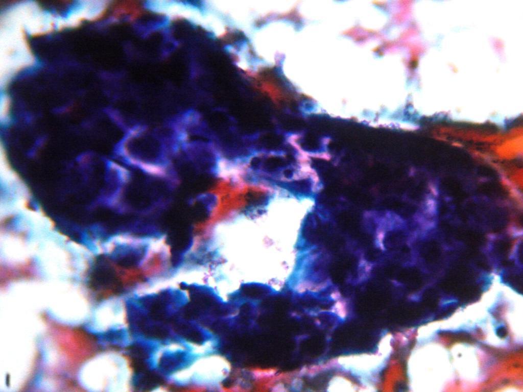 Figure 3: Photomicrograph of FNAC smear: Cytological Grade III showing cells with marked pleomorphism, prominent nucleoli and granular chromatin (Papanicolaoux400) In the present study, histological