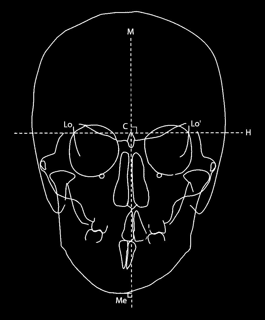 A perpendicular line through sella was used as the y axis.the mandibular plane was defined as the line between gonion (Go) and menton (Me). Fig 2 (right) Planes and landmarks in frontal cephalogram.