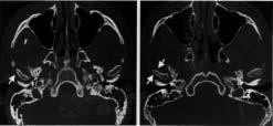 midpoint of Lo and Lo on LOL; Me = menton. a Fig 3 Typical images of condylar bony change in TMJ X-ray CT in axial section. Arrows show flattening (a) and deformity (b).