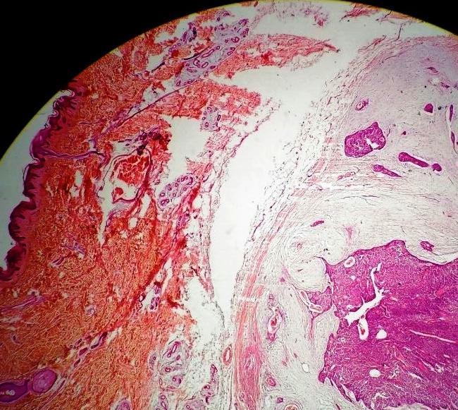 (a) Histopathology showing solid and cystic areas separated by hyalinized band of collagen; solid component composed of