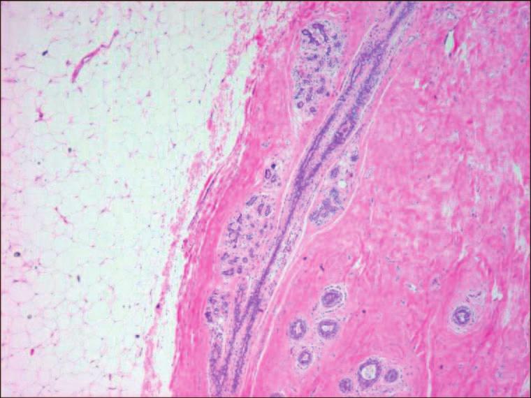 NORMAL HISTOLOGY AND METAPLASIAS Figure 1.3. Normal breast parenchyma composed of adipose and fibroglandular tissue.
