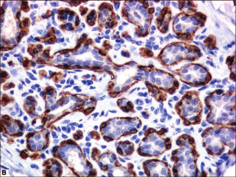 BREAST Figure 1.4. (continued) (B) Calponin immunostain highlighting the myoepithelial cell layer in the lobule. Figure 1.5.