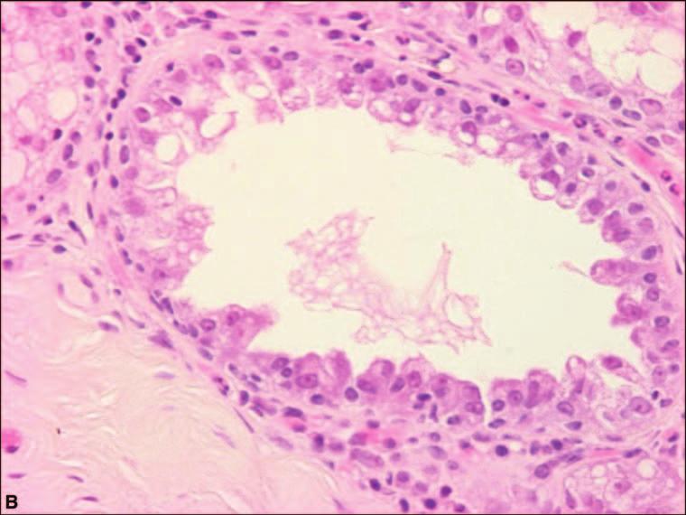 NORMAL HISTOLOGY AND METAPLASIAS