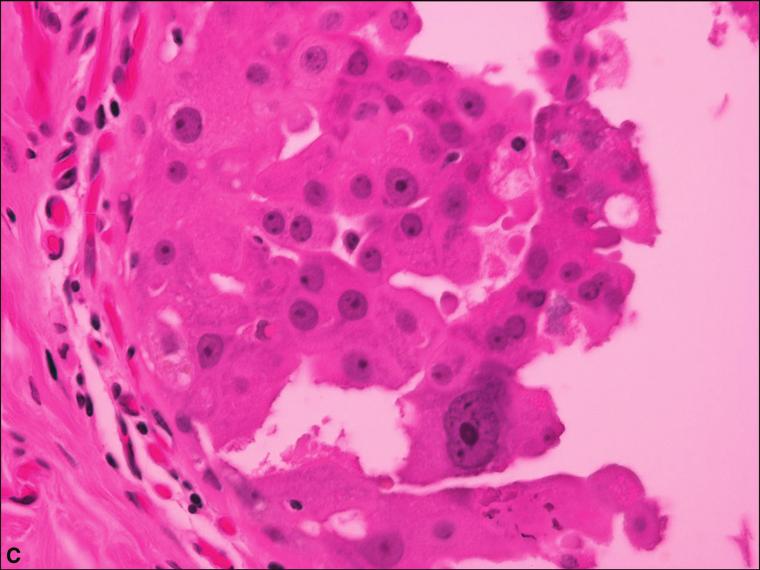 Cambridge University Press NORMAL HISTOLOGY AND METAPLASIAS Figure 1.7. (continued) Figure 1.8. Clear cell change in a lobule.