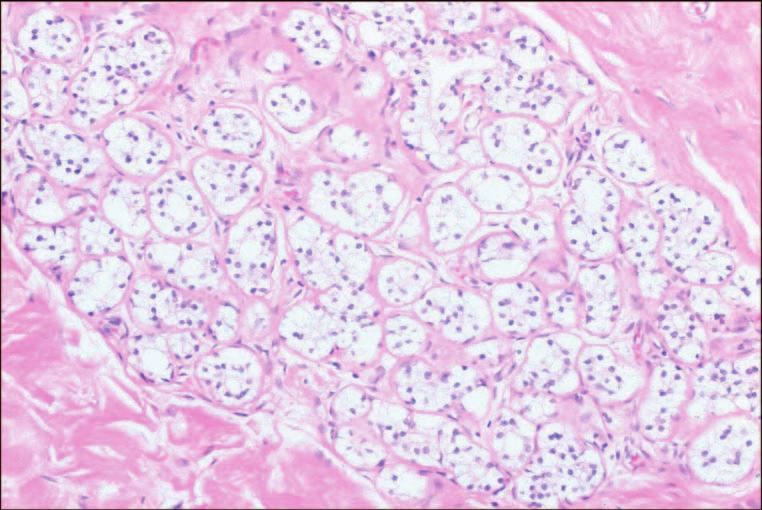 Generally, this is not a difﬁcult distinction, and the absence of a clear cell in situ carcinoma elsewhere in the specimen and the bland