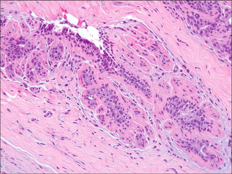 BREAST Figure 1.9. Myoid metaplasia. Note the pronounced pink myoepithelial cells with a prominent muscle-like appearance.